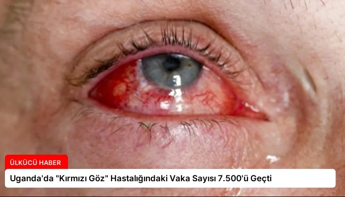 Uganda’da “Kırmızı Göz” Hastalığındaki Vaka Sayısı 7.500’ü Geçti